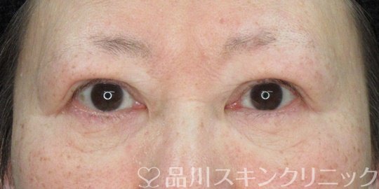 症例NO.75082のAFTER写真
