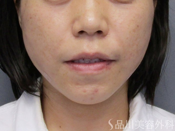 症例NO.74824のAFTER写真