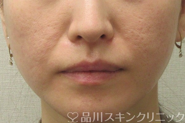 症例NO.72746のBEFORE写真