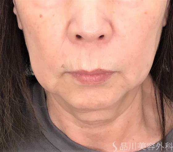 症例NO.55546のBEFORE写真