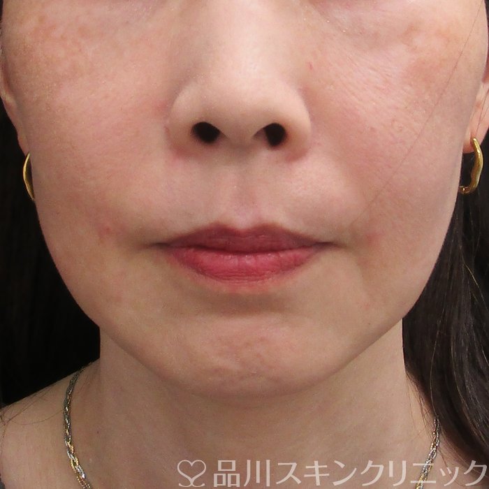 症例NO.73430のAFTER写真