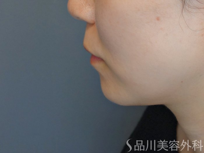 症例NO.68180のBEFORE写真