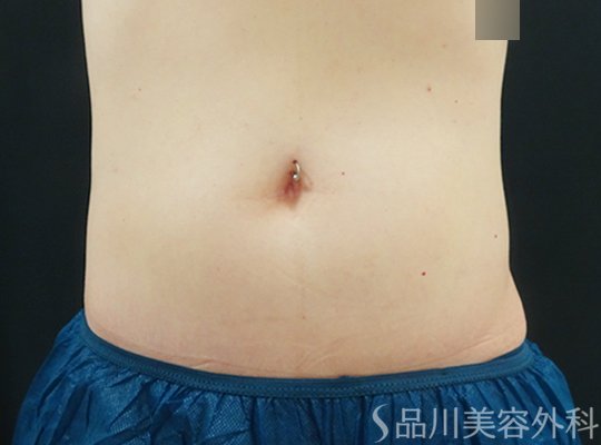 症例NO.70205のAFTER写真
