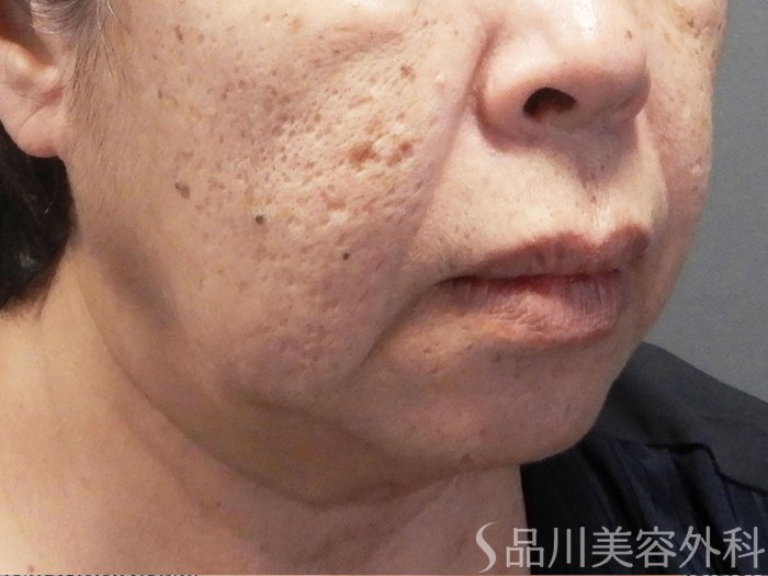 症例NO.71431のBEFORE写真