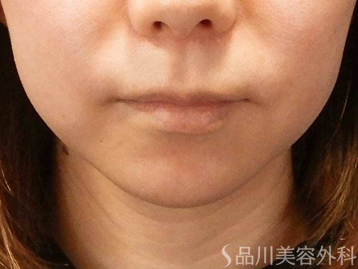 症例NO.70058のBEFORE写真