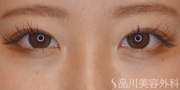 症例NO.68465のBEFORE写真