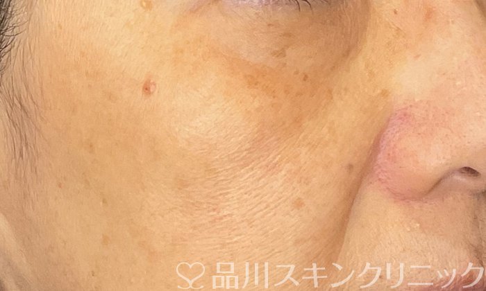 症例NO.72787のAFTER写真