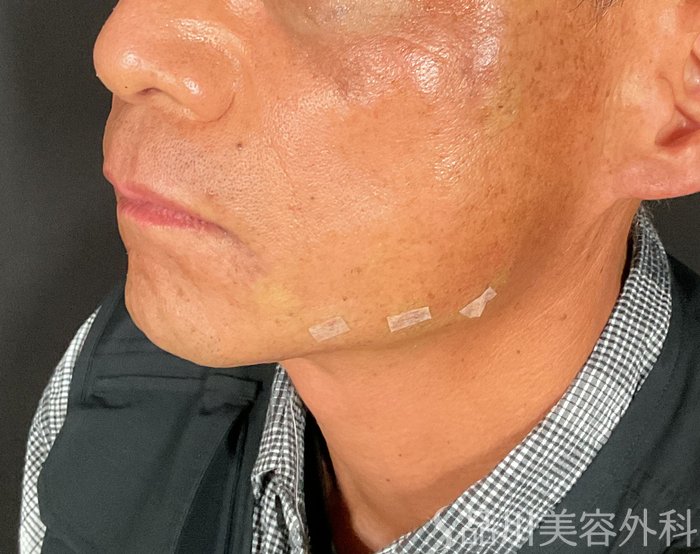 症例NO.75000のAFTER写真