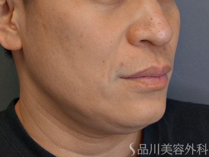 症例NO.73048のBEFORE写真