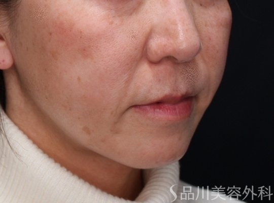 症例NO.72705のAFTER写真