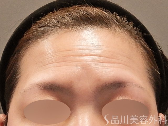 症例NO.72800のBEFORE写真