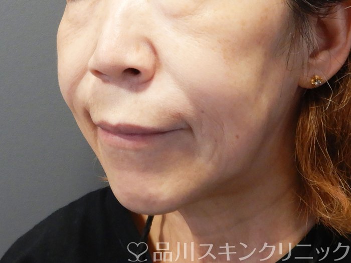 症例NO.72486のBEFORE写真
