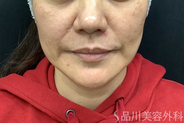 症例NO.69667のBEFORE写真
