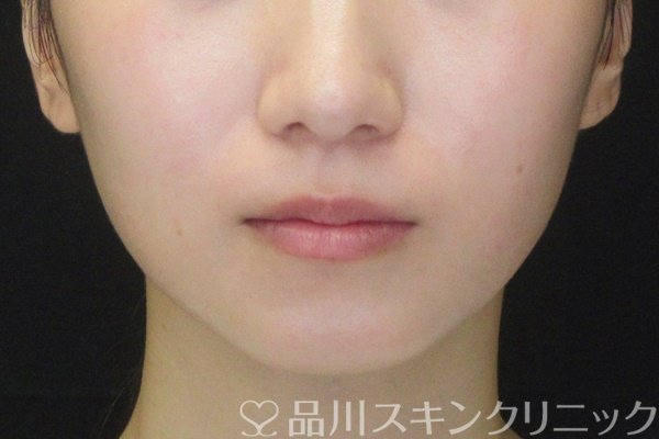 症例NO.64684のAFTER写真
