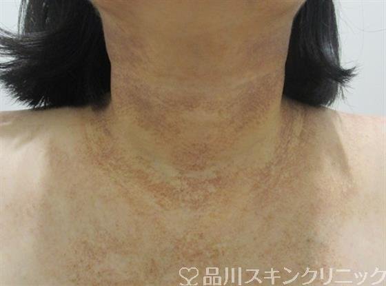 症例NO.41795のAFTER写真
