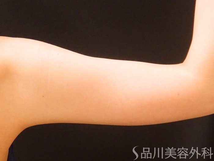 症例NO.67663のAFTER写真