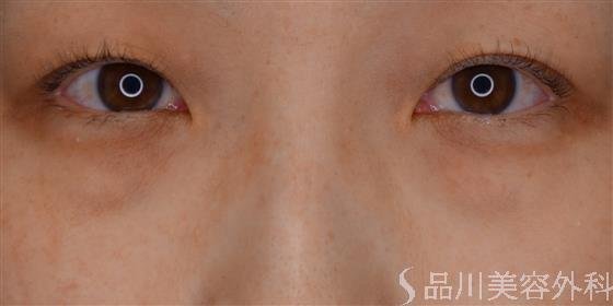 症例NO.61303のBEFORE写真
