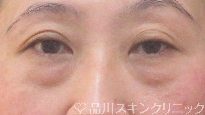 症例NO.72643のBEFORE写真