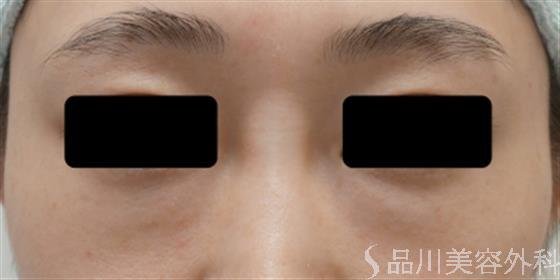 症例NO.35433のBEFORE写真