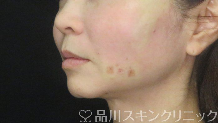 症例NO.72623のAFTER写真