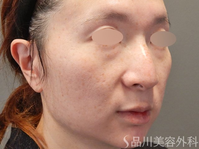症例NO.74574のBEFORE写真
