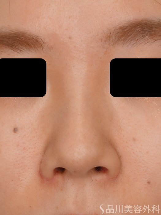 症例NO.73356のAFTER写真