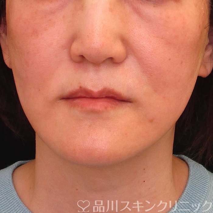 症例NO.65608のAFTER写真