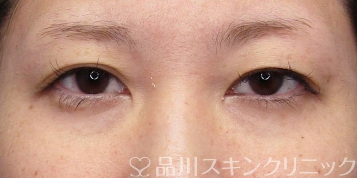 症例NO.75023のBEFORE写真