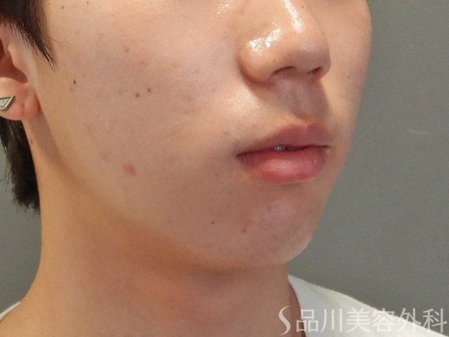 症例NO.74901のBEFORE写真