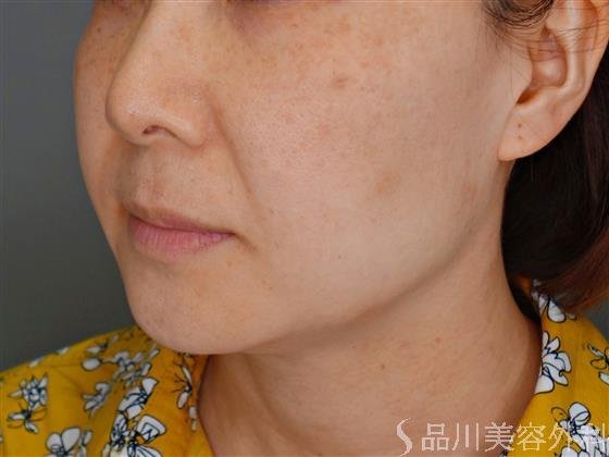 症例NO.51282のBEFORE写真