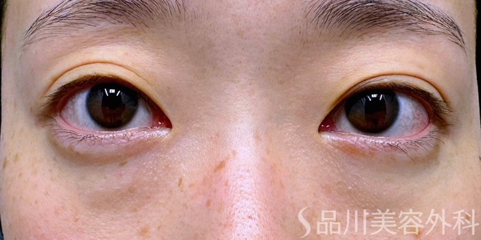 症例NO.74760のBEFORE写真