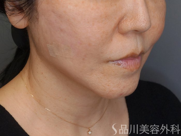 症例NO.72942のAFTER写真