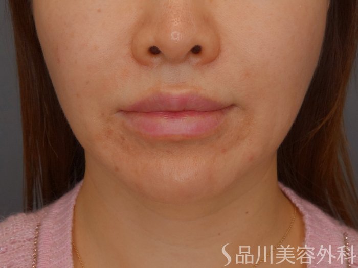 症例NO.72802のBEFORE写真