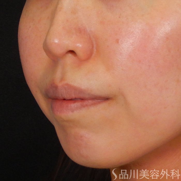 症例NO.67722のBEFORE写真