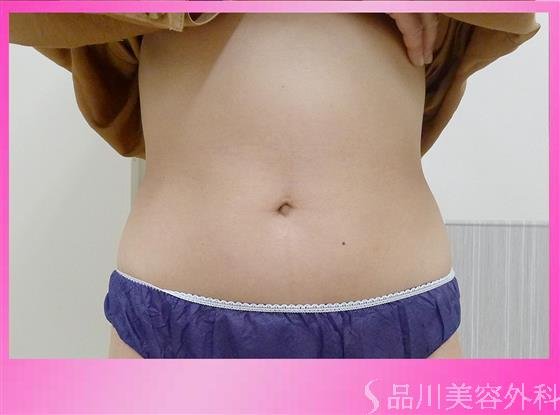 症例NO.45970のBEFORE写真