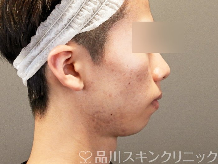 症例NO.65027のBEFORE写真
