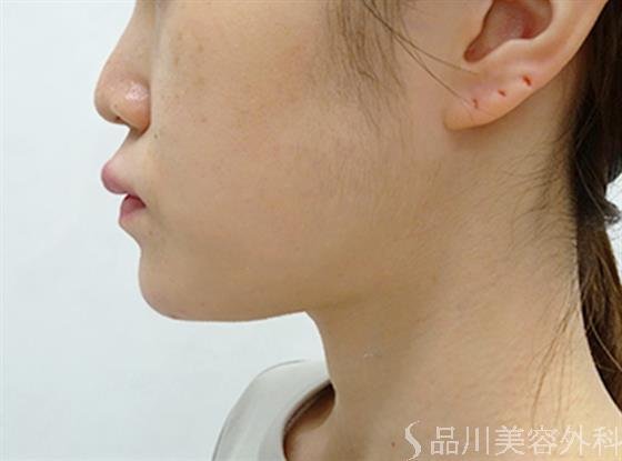 症例NO.51373のAFTER写真