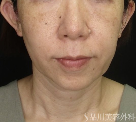 症例NO.71718のBEFORE写真