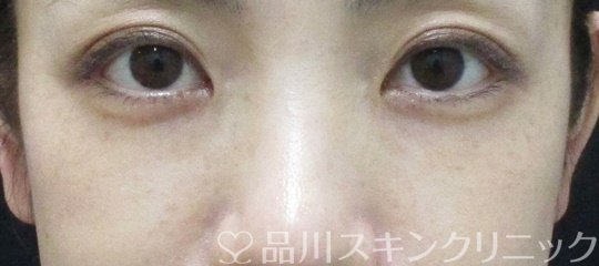 症例NO.74796のAFTER写真