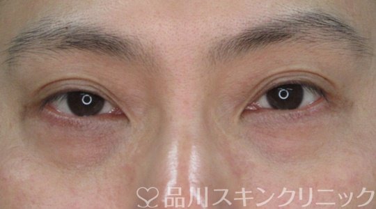 症例NO.71113のBEFORE写真