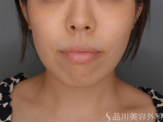 症例NO.56768のBEFORE写真
