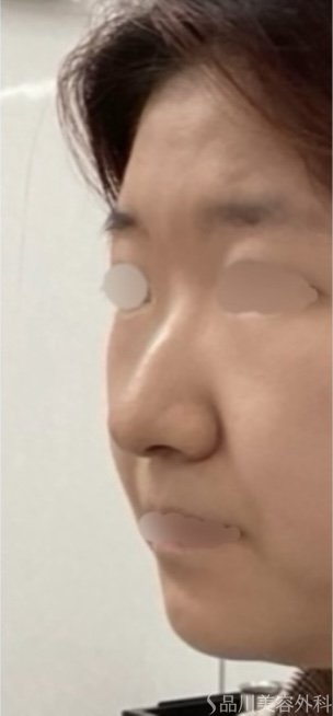 症例NO.72684のBEFORE写真