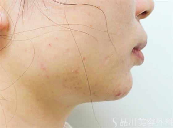 症例NO.33010のAFTER写真