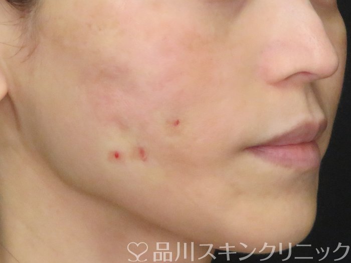 症例NO.70721のAFTER写真