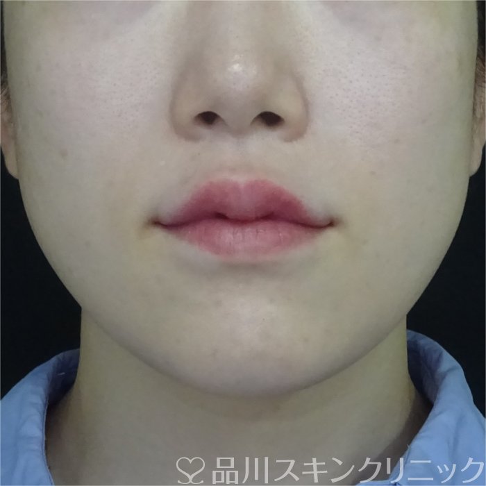 症例NO.70902のAFTER写真