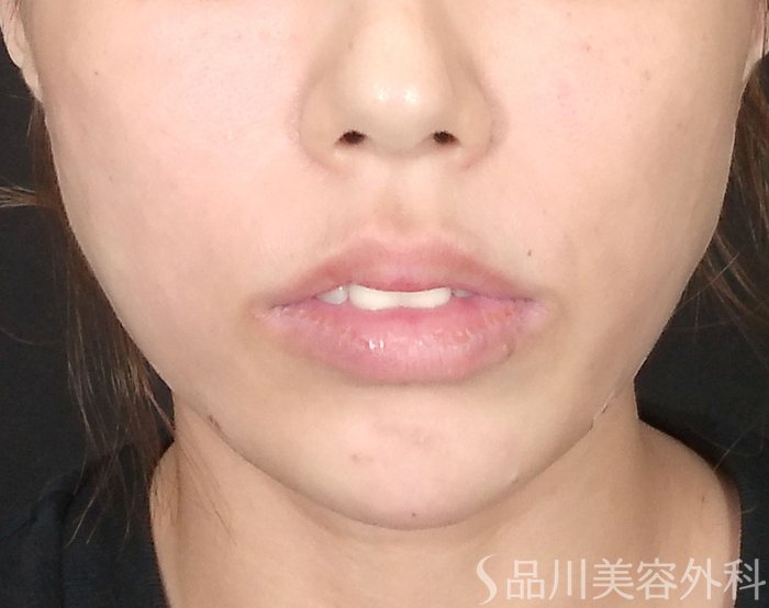 症例NO.69522のAFTER写真