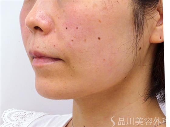 症例NO.51809のAFTER写真