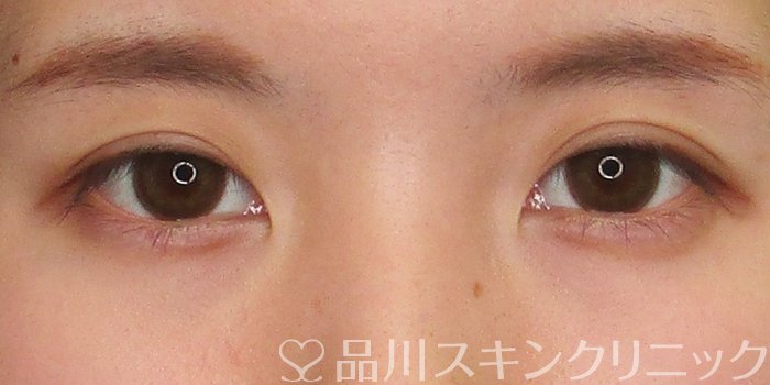 症例NO.70158のBEFORE写真