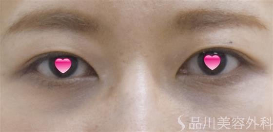 症例NO.52437のAFTER写真