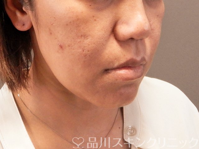 症例NO.70984のBEFORE写真